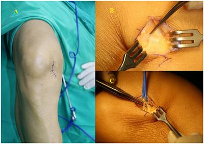 Case report: A case of injury to the infrapatellar branch of the saphenous nerve caused by medial approach in knee arthroscopy